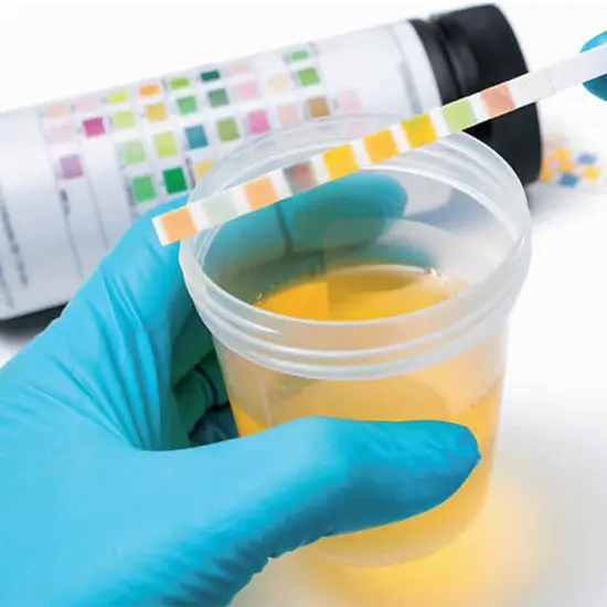 catecholamines, urine test